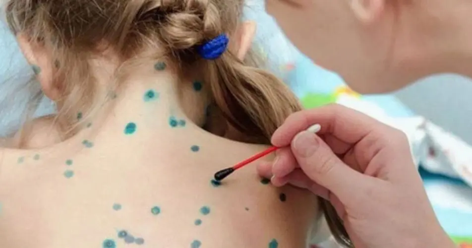 Вітрянка: чим мазати висипку без ризику шрамів0